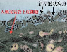 香港大學李嘉誠醫學院研究指出，新型冠狀病毒能感染肺部負責氧氣交換的細胞，並能由肺部擴散至其他器官，其複製速度比沙士還快。